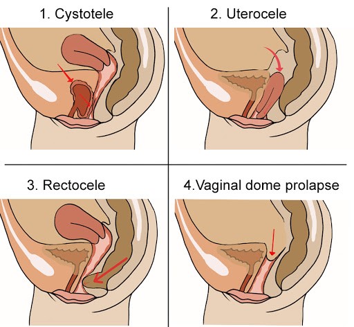 prolapso