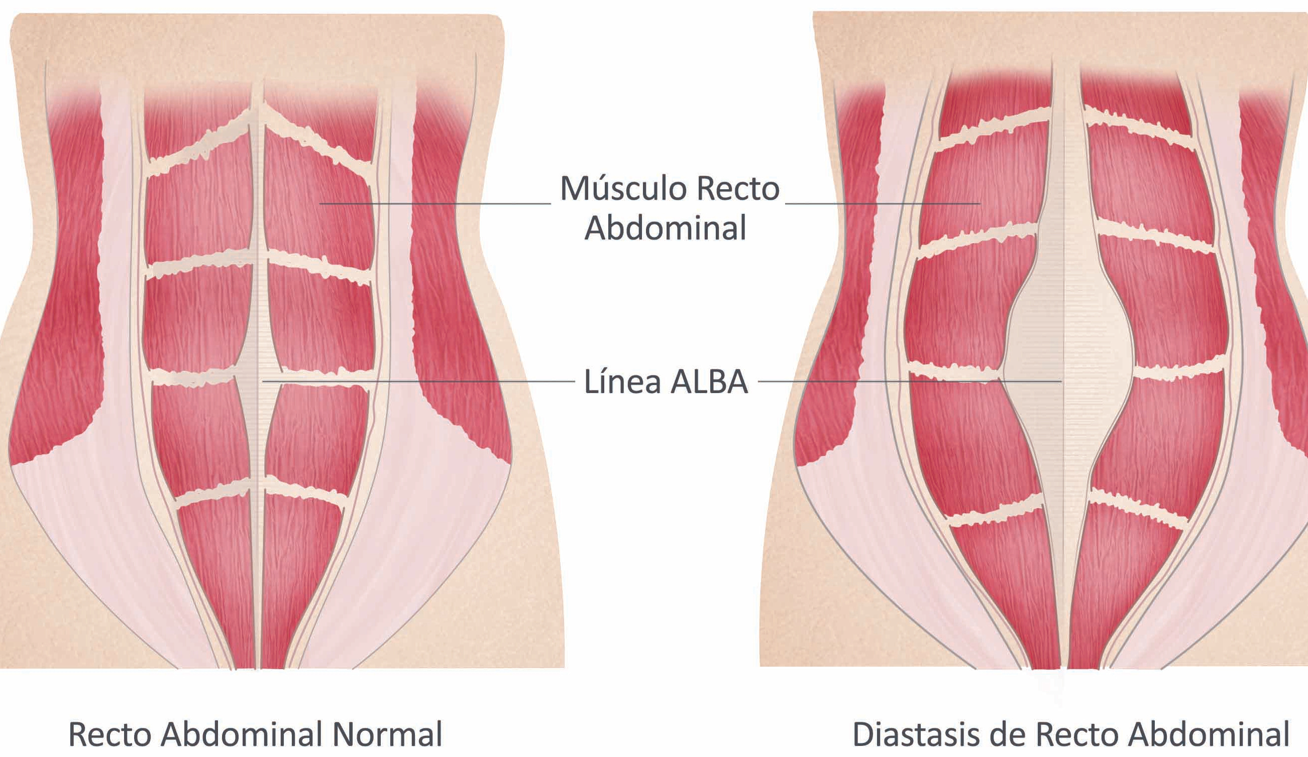 diastasis_abdominal